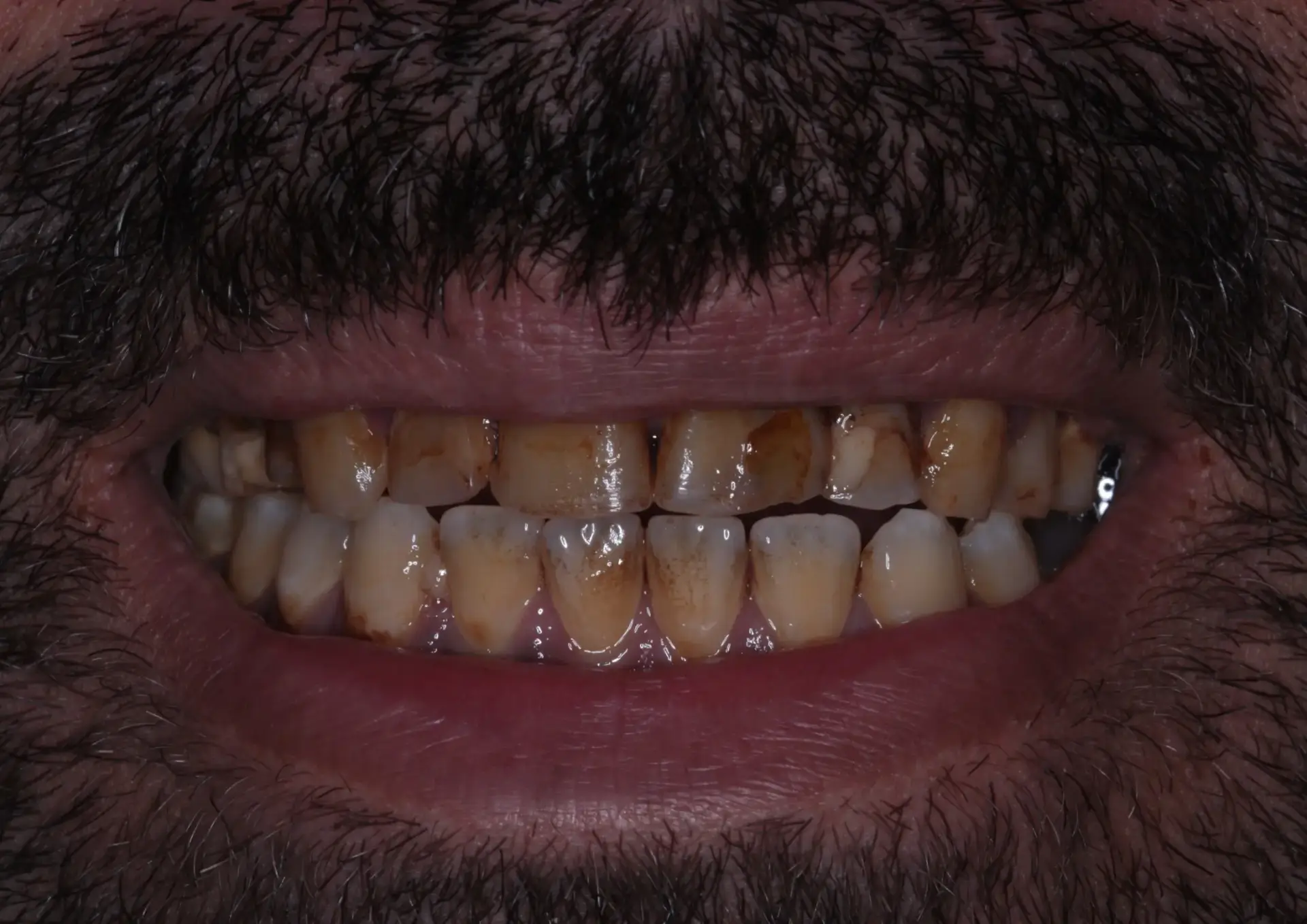 Picture 1 Full mouth rehabilitation