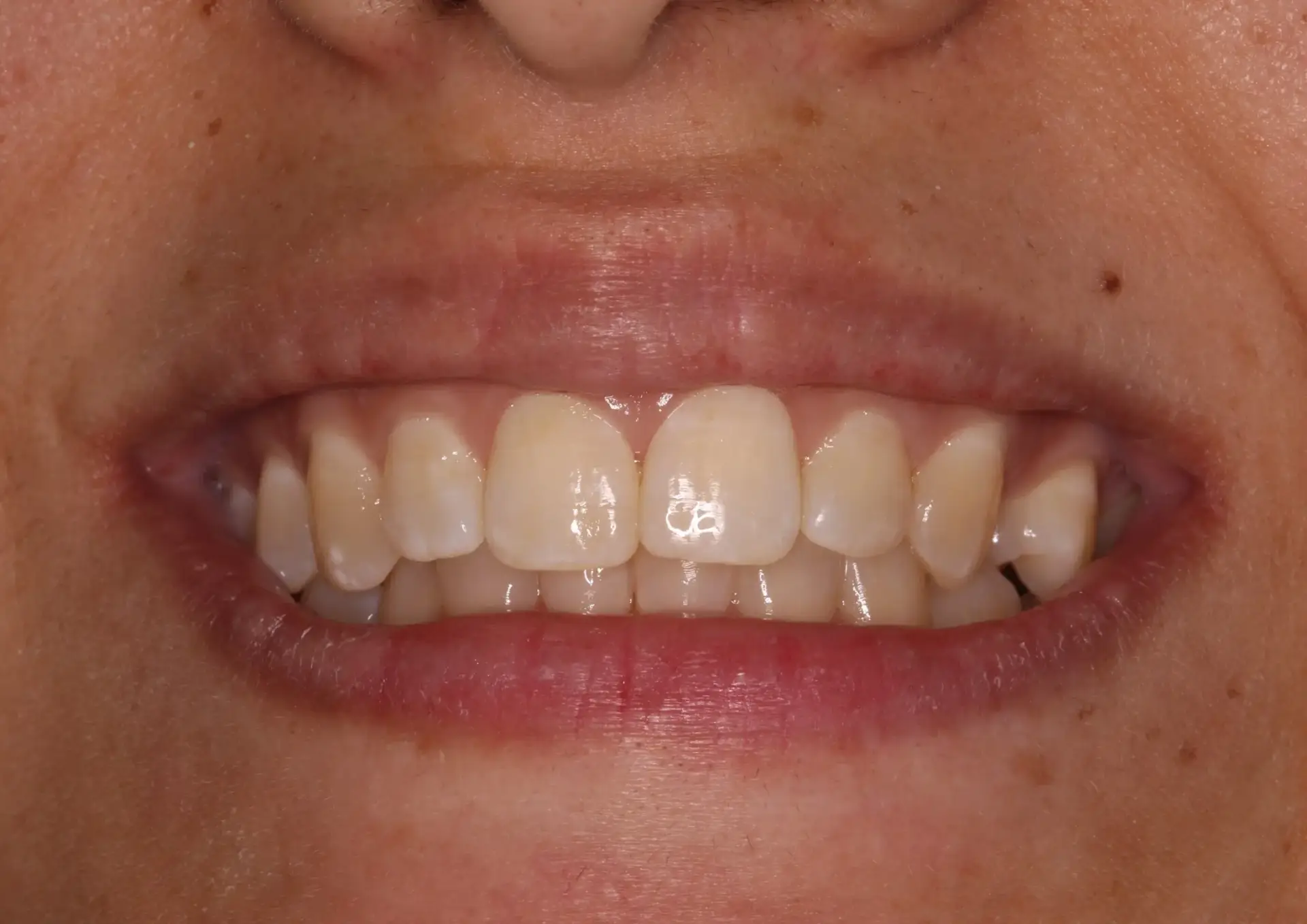 Picture 1 Teeth whitening