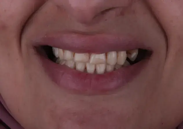 Picture 1 Veneers and implants