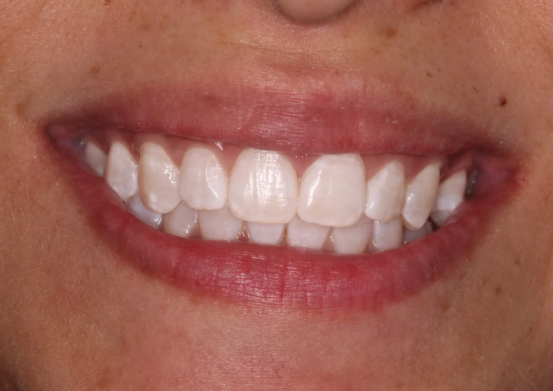 Picture 2 Teeth whitening