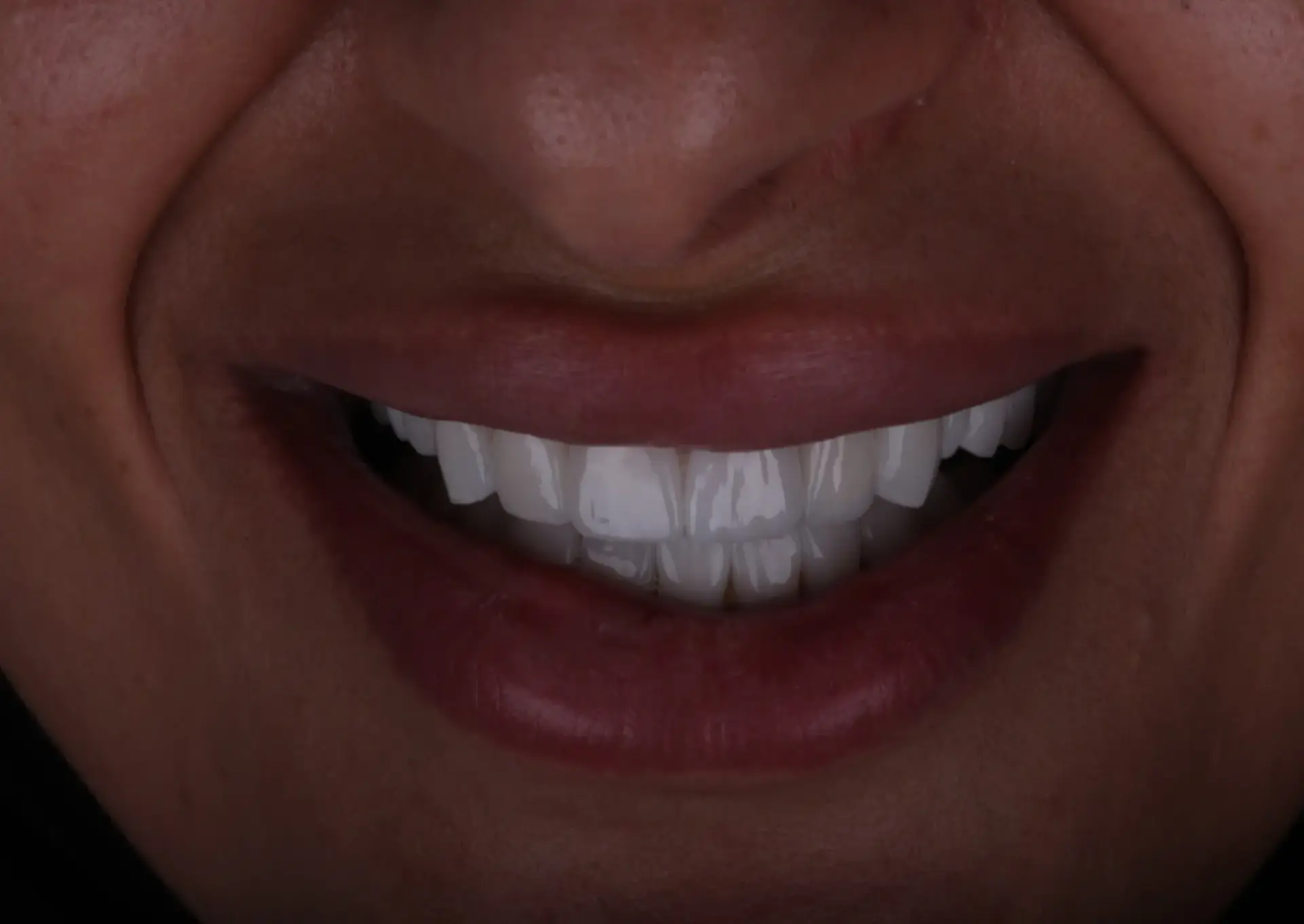 Picture 2 Veneers and implants