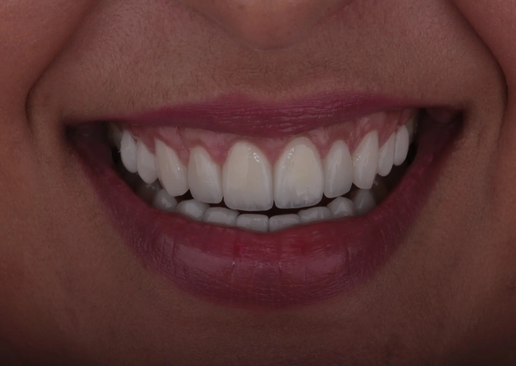 Picture 2 Veneers