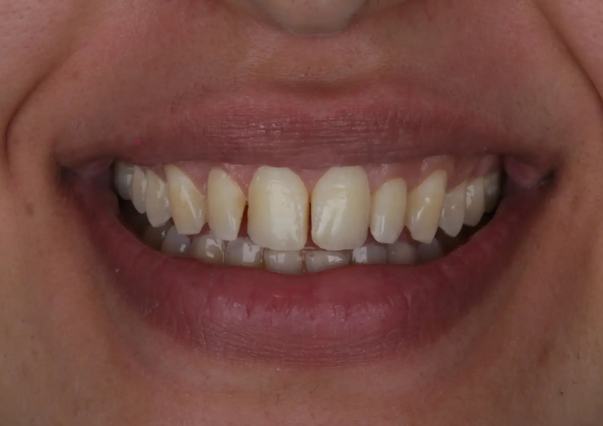 Picture1 Veneers