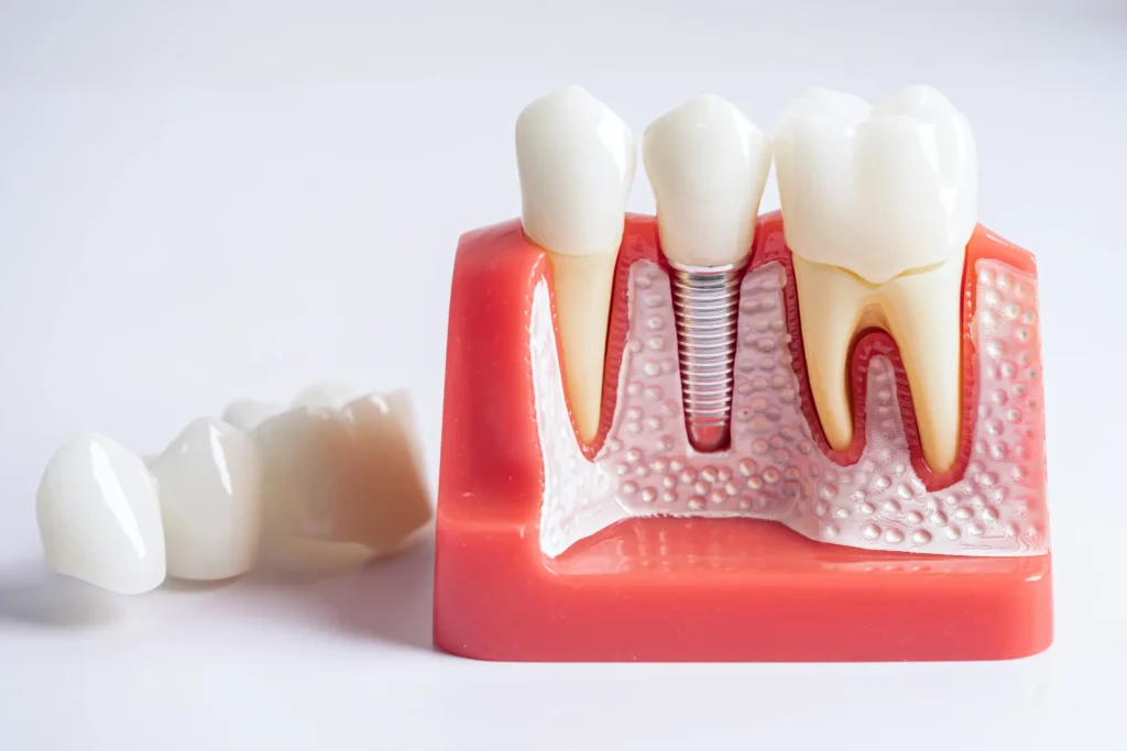 Dental crowns: When and why, you need one